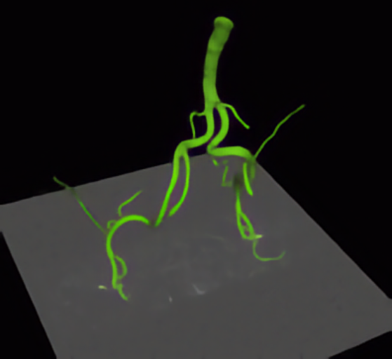 Medical Image Analysis: Model-based Segmentation of Vessels from 3D Tomographic Images